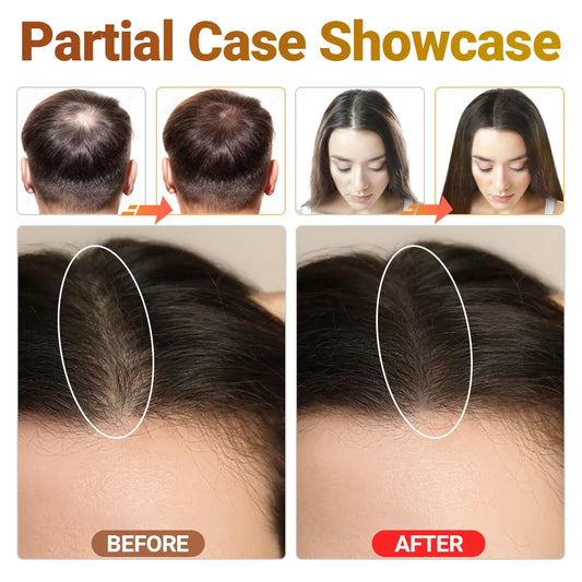 Clinical Grade Lllt Hair Regrowth Device Anti Hair | Premium Care