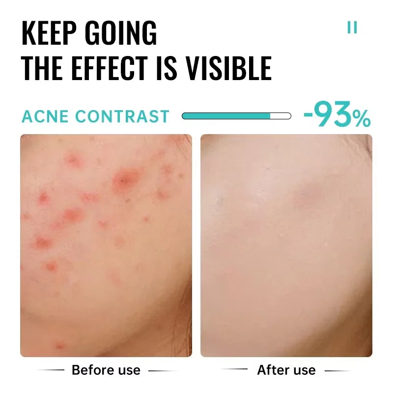 Salicylic Acid Acne Treatment Face Cream Repair Pimple | Premium Care