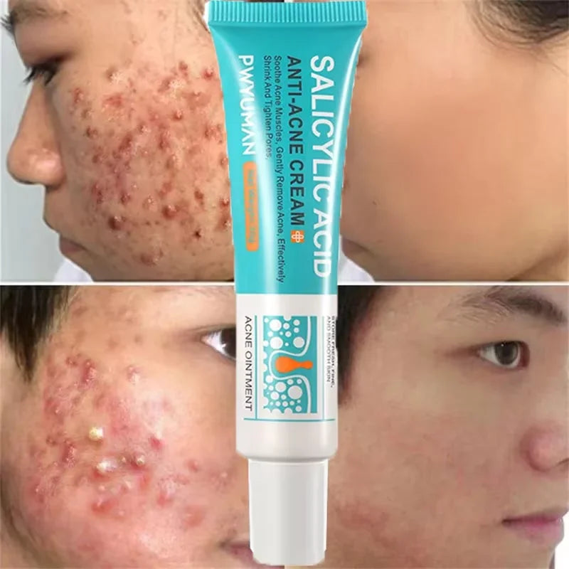 Salicylic Acid Acne Treatment Face Cream Repair Pimple | Premium Care