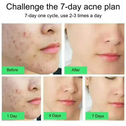 Salicylic Acid Acne Treatment Face Cream Repair Pimple | Premium Care