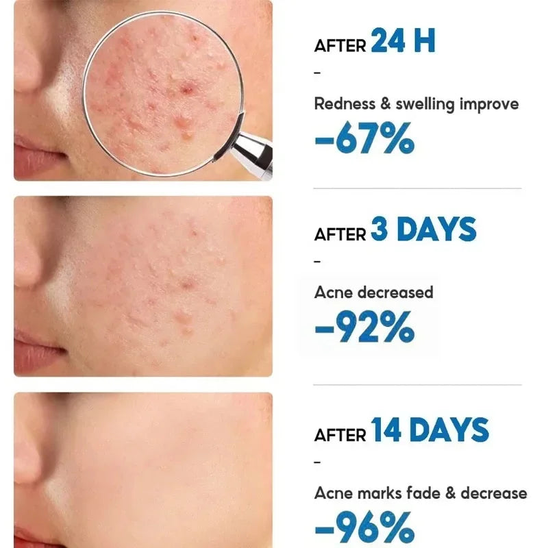 Salicylic Acid Acne Removal Cream Anti Acne Repair | Premium Care