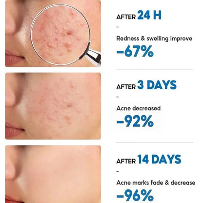 Salicylic Acid Acne Removal Cream Anti Acne Repair | Premium Care