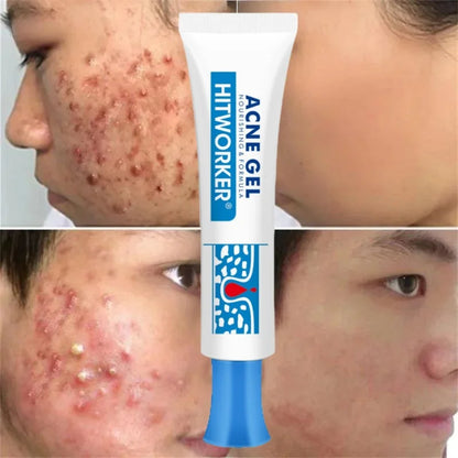 Salicylic Acid Acne Removal Cream Anti Acne Repair | Premium Care