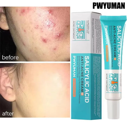Salicylic Acid Acne Treatment Face Cream Repair Pimple | Premium Care