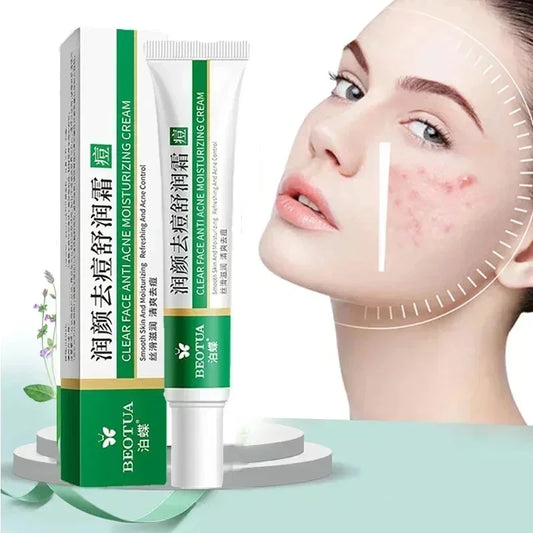 Herbal Acne Treatment Cream Face Scar Blackhead Remover | Premium Care