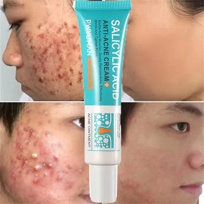 Salicylic Acid Acne Treatment Face Cream Repair Pimple | Premium Care
