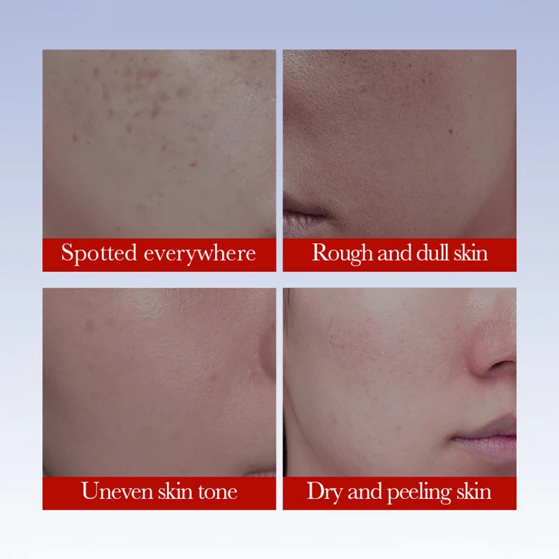 Sadoer Anti Freckle Cream Face Whitening Creams Spot | Premium Care