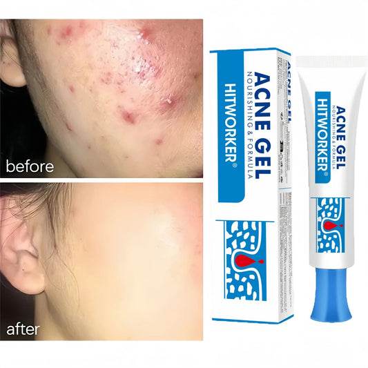 Salicylic Acid Acne Removal Cream Anti Acne Repair | Premium Care